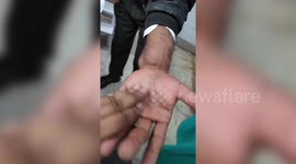 Graphic Content: Remarkable achievement! Successful plastic surgery performed on patient with hand tumor in central India