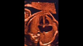 The fetal heart at 20 weeks gestation. This is the ‘4 chamber’ view.