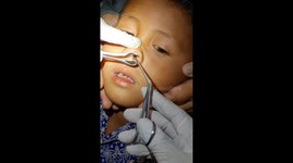 kejadian luar biasa besarnya sejenis binatang pacet / Haemadipsa bersarang di Hidungnya hampir 1 bulan. Akhirnya berhasil saya  keluarkan di tempat prakek