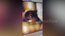 Surgeons save 11-year-old girl's life by removing piece of chicken cartilage stuck in her throat