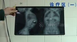 一岁小孩误吞硬币 医生全麻镜下取出