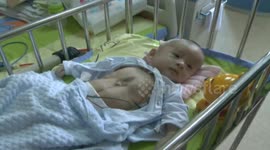 重庆“外心人”男婴：心脏与外界只有一层薄膜