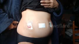 The Day after Hysterectomy /Hysteroscopy. The swelling and incisions.