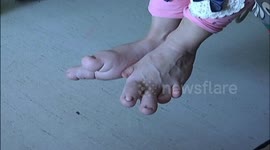 乌鲁木齐：“巨脚”女童渴望穿鞋