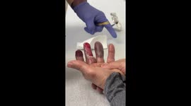 Woman Receives Treatment for Severe Frostbite