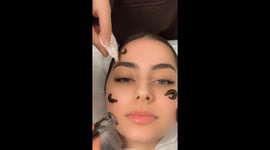 Would you let leeches on your face? Woman films controversial facial therapy