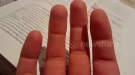 Exposing my burned fingers !