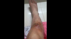 One Week of Pimple Growth Ends with a Massive Burst