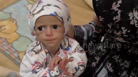 5-month-old Palestinian baby suffers from malnutrition amid Gaza blockade