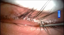 Lice are removed from five-year-old girl's eyelashes