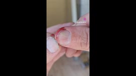 Man's painstaking removal of splinter from under his fingernail