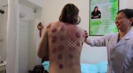 YouTuber tests 'cupping' to see what all the fuss is about at the Olympics
