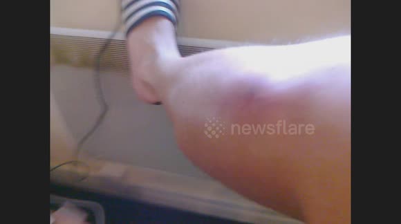 Bitten 3 times by a false widow spider that came into my kitchen