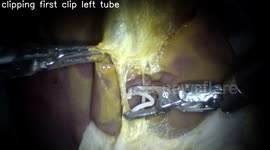 US: Robot Performs Complex Surgery With Zero Human Help For The First Time