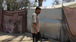 Palestinian teen burned in Gaza airstrike battles ongoing pain nearly year later