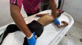 Starvation kills 15 Gazans, including 4 children, in last 24 hours: Health Ministry