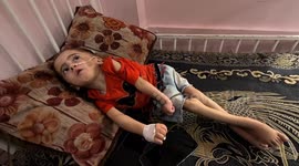 Malnourished children in Gaza face death amid ongoing humanitarian crisis