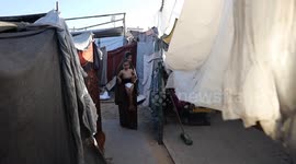 Malnutrition threatens life of 4-year-old in Gaza refugee camp