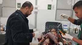 Gaza girl, 9, who lost leg in Israeli attack, hopes to play without crutches again