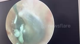 Doctors remove cement that fell into the man's ear canal and hardened on his eardrum