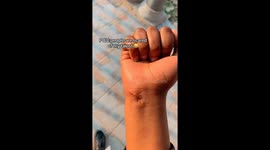 got injured on my hand and i almost died