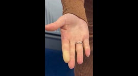 When the Solution to Fix Your Reynauds Doesn’t Work