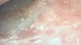 Doctor Horrified to Discover a Bed Bug Infestation in Patient's Ear Canal