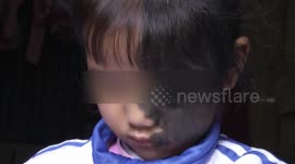 Family of girl with hairy face seek to crowdfund treatment