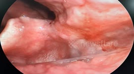 Throat Emergency: Doctors Extract 9cm Fish Bone From Man's Throat!