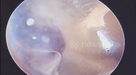 Unbelievable! Tumor Behind Eardrum Reacts to Man's Voice in Vietnam