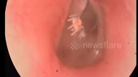 A Spider Lives in Man's Ear Canal, Spinning Webs and Nesting for a Month