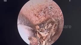 Doctors remove giant butterfly that crawled into woman's ear canal