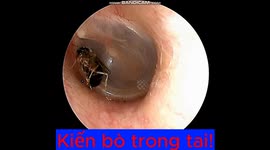 The queen ant crawled into the man's ear canal and laid her eggs there