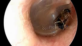 The queen ant crawled into the man's ear canal and laid her eggs there
