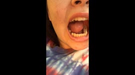 Morganna loosing her last tooth at 15, in 2020