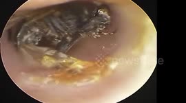 Doctors remove a fly that had been stuck in a man's ear canal for Two weeks