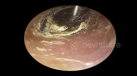 White mushroom covered the beetle carcass inside the man's ear cana