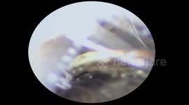 Doctors remove giant cockroach stuck in woman's ear canal