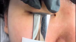Chinese woman underwent eyeliner washing with laser technology