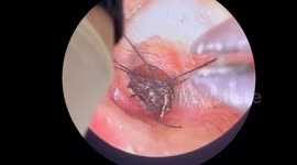 Giant mosquito crawled into the man's ear canal and punctured his eardrum