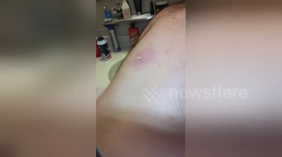 Newsflare Newsflare Edit Squirting Puss Out Of An Ingrown Hair