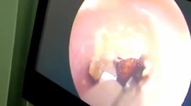 怀化：蟑螂爬入女子耳道 医生提醒不要在床头吃食物遗留残渣