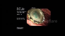 Doctor in east China's Jiangsu province used a condom to pull out a beer bottle cap a man swallowed in his stomach